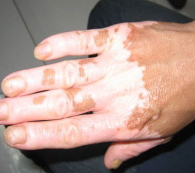 手部白癜风常见的病因有哪些